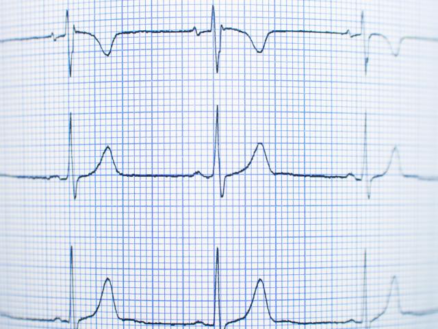 Diagnose Herzrhythmusstörungen - Elektrokardiogramm EKG
