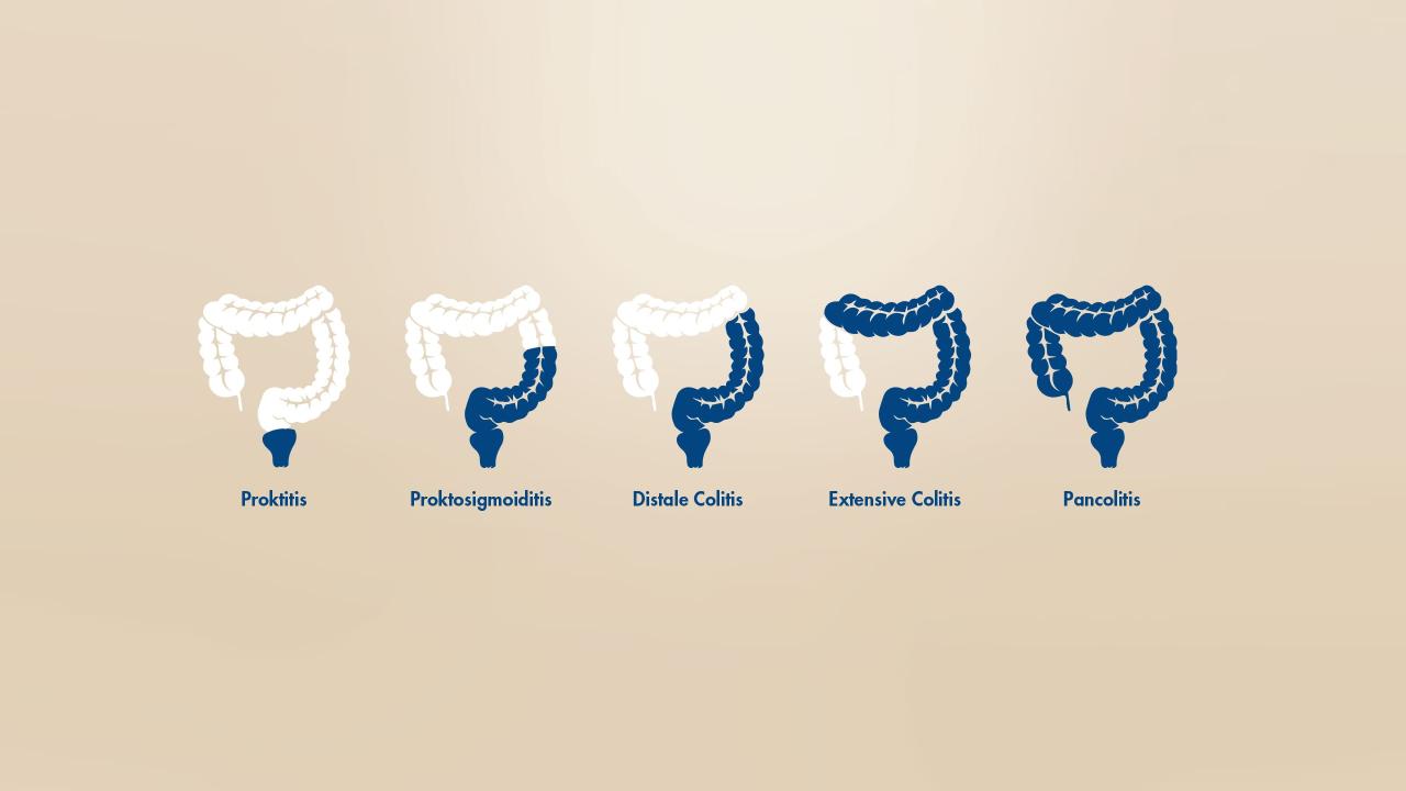 Darstellung der verschiedenen Formen der Colitis ulcerosa nach betroffenem Darmabschnitt