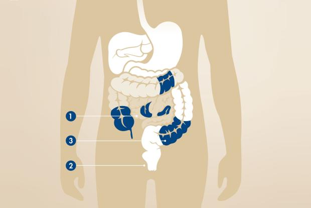 Darstellung der verschiedenen Darmabschnitt, die bei Morbus Crohn betroffen sein können